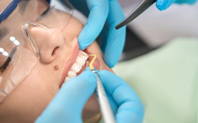 The Truth About Plaque: Why It Forms Faster Than You Think